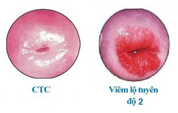 Hình ảnh viêm lộ tuyến cổ tử cung độ 2