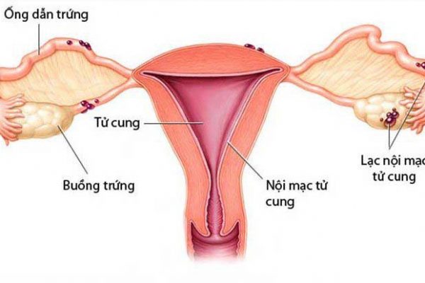 Lạc nội mạc cổ tử cung: Nguyên nhân, triệu chứng, cách điều trị